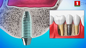 Технологии имплантации зубов, высокое давление у мужчин, водно-солевой баланс организма - в программе Здоровье