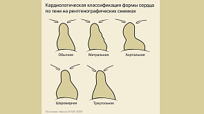 Люди с какой формой сердца живут меньше